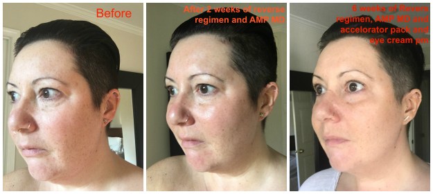 my-6-week-before-and-after-Rodan + Fields